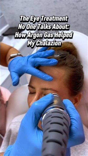 The Eye Treatment No One Talks About: How Argon Gas Helped My Chalazion ⤵️