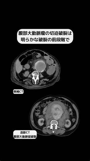 Impending Abdominal Aortic Aneurysm Rupture #radiology #diagnosticimaging #shorts