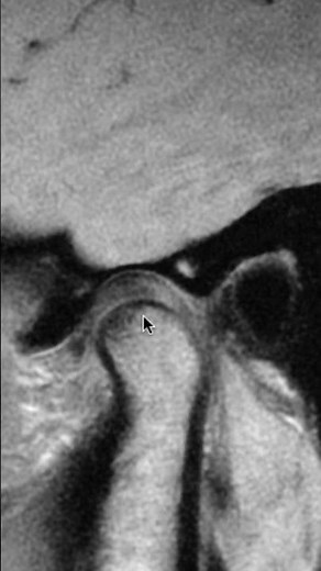 Anatomía de la ARTICULACIÓN TEMPOROMANDIBULAR en RM