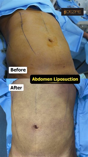 Abdomen Liposuction