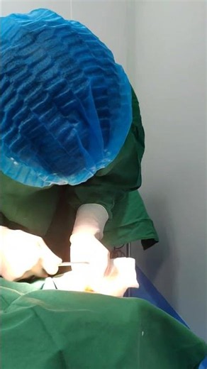 手术矫正大脚骨过程，拇趾外翻手术矫正，大脚骨手术矫正 #hallux