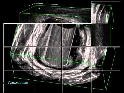Video Kurs Teil 1 anale / rektale Endosonographie