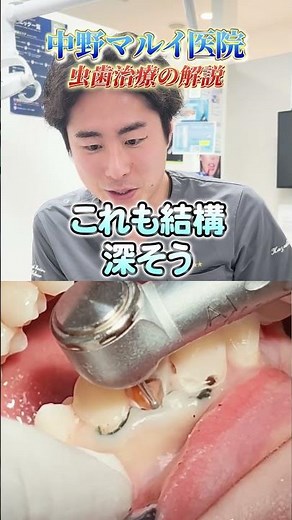 虫歯治療の解説！
