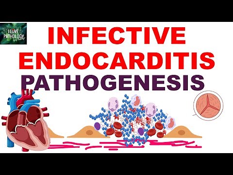 INFECTIVE ENDOCARDITIS Part 1: Risk Factors & Pathogenesis