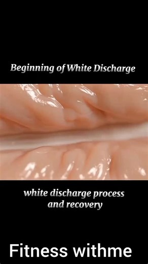 healthandwellness | Beginning of white discharge process and recovery . . . . . . . #vaginaldischarge #vaginalhealth #womenshealth #vagina #yeastinfection... | Instagram