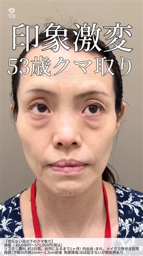 【クマ取り】TCB理事長 梅田大阪駅前院院長 ドクタービーバー寺西宏王医師 on Instagram: "他の激変症例を見る→ @tcb_teranishi 👍✨ 53歳の患者様。 クマが原因で写真を撮った時に老けた感じに見えるのがお悩みでした。 ふくらみによるクマが大きく凹みも強い方でしたので 切開や脂肪注入の併用がおすすめですが患者様のダウンタイムを考慮し 今回はクマ取りとヒアルロン酸で施術を行いました！ １ヶ月後には明るい目の下になりましたね。 以前は家族写真も撮る側だったそうですが今は一緒に撮ろうかなと思うまでに！ クマもなくなり、目が大きくなったように思うと喜ばれてました！ 施術内容 ・目の下のクマ取り ・ヒアルロン酸注入（目の下) —————— 寺西宏王 Hiroo Teranishi ♦︎TCB理事長 ♦︎梅田大阪駅前院院長 ♦︎二重整形指導最高責任者 ♦︎JAPSA(日本美容医療学会)代表理事 心臓血管外科医時代に培った丁寧で正確な手技とスピードに定評あり。 特に二重埋没とクマ取り、鼻の3施術の人気が高く、 その人気の高さは圧倒的な症例実績からも見て取れる。国内のみな