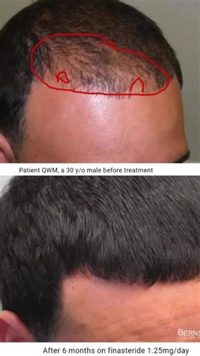 Finasteride Results #hairlosshelp2023 #finasteride #finasterida #hairloss #hairhelp #hairstyle #balding #baldingsolution #hairregrowth #hairregrowthjourney #propecia