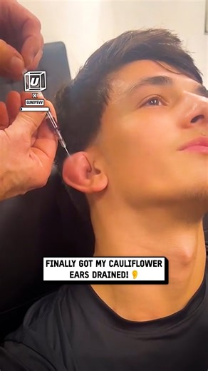 I got my cauliflower ear drained 🤯🥴 #cauliflowerear #boxing | UNILAD