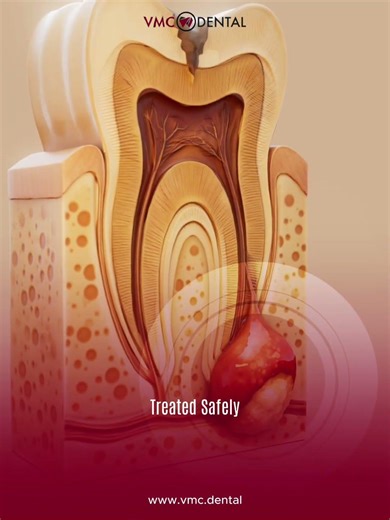 Tooth Extraction! What you should know?