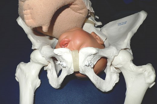 Asynclitism - A Helpful Guide and Solutions - Spinning Babies