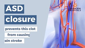 Atrial septal defect refers to a hole in the wall between the two upper chambers of your heart, allowing blood to leak and putting the heart at potential risk. Most ASD’s are diagnosed & treated successfully with few or no complications. Meet an expert cardiologist in order to best manage the condition - https://www.yashodahospitals.com/doctor/doctor-department/cardiology/ #atrialseptaldefect #cardio #heartdisease | Yashoda Hospitals