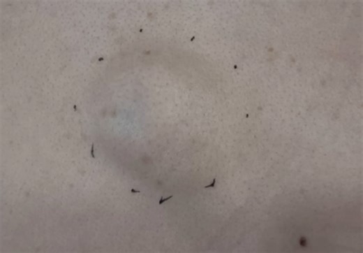 Creamy Sebaceous Cyst on Back Incision and Drainage