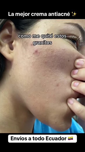 Crema Antiacné con Ácido Salicílico: Tu Rutina de Noche para una Piel Más Clara y Suave