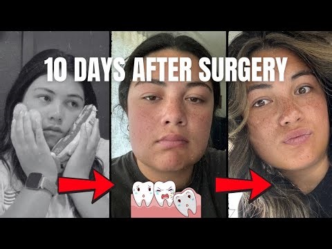 What Wisdom Teeth Recovery Is Really Like | Day 1–10 + 5 Weeks Later
