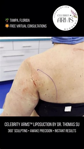 “Oh my goodness!” 🤩 This patient is seeing her Celebrity Arms™ Liposuction results with Dr. Thomas Su in real time. One arm sculpted, the other untouched — the instant difference is undeniable. You can see her shoulder contour and arm definition come to life right before her eyes. 💫 Dr. Su’s exclusive 360° technique removes up to 90% of fat around the entire arm, not just the back like traditional lipo. By sculpting the front, sides, and shoulders too, the arms are transformed completely — sli