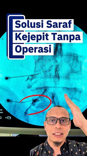 Solusi Saraf Kejepit tanpa Operasi dengan Radiofrekuensi