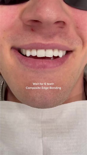 Enhancing Teeth with Composite Edge Bonding