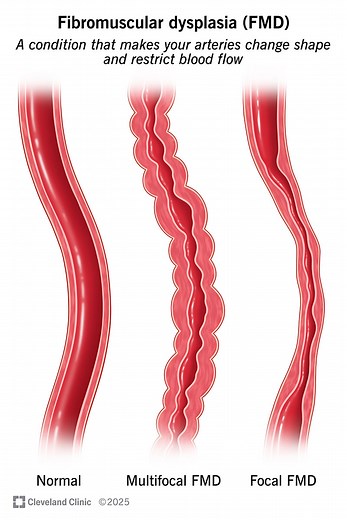 What Is Fibromuscular Dysplasia?