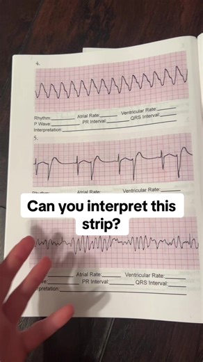 Understanding Bigeminy: A Unique Cardiac Rhythm
