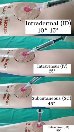 #Types of injection #angle💉