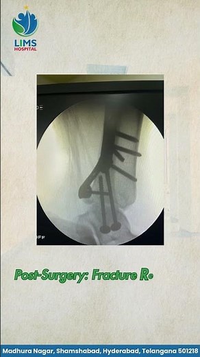 Successful ORIF Surgery for Complex Ankle Fracture | LIMS Hospital Shamshabad