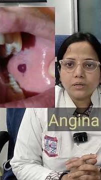 Blood filled blister inside mouth.Angina Bullosa Hemorrhagica.Blood filled blister kya hota#shorts..