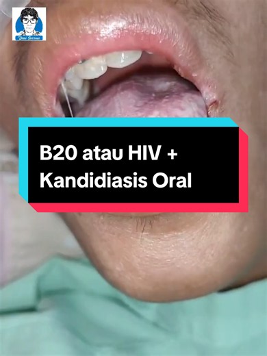 B20 atau HIV laki usia 20 thn L**T#aids#edukasiparudenisoeroso#viral#fypシ#fyp @Praktek dr Deni Soeroso @Alarick Soeroso