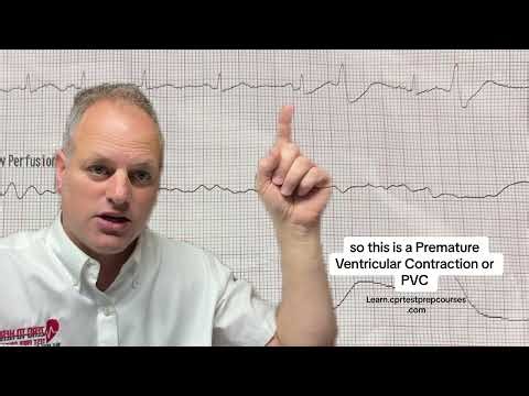 EKG analysis of PVC’s (Premature Ventricular Contractions)