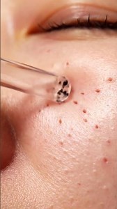 Nose Pore Blackhead Removal — Smooth