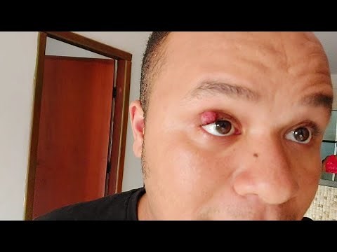 PRECISEI PASSAR POR UMA CIRURGIA PARA TIRAR UM CALÁZIO DO OLHO ESQUERDO - Doeu muito😢