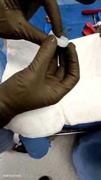 Meniscus Replacement Procedure (MRP) at 75