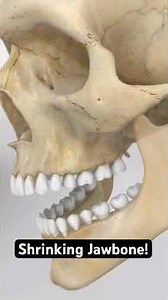 Yes—Your Jawbone Can Shrink After Losing a Tooth