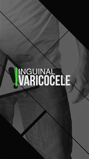 Varicocele. Cirugía en 3 días. La mejor técnica.