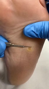 Dive into the world of podiatry with this intriguing corn removal! . . . #footpain #plantarfasciitis #heelpain #podiatry #footcare #podiatrist #orthotics #feet #foothealth #kneepain #foot #running #anklepain #backpain #bunions #flatfeet #healthyfeet #footpainrelief #arthritis #health #footdoctor #bunion #fyp #foryou #viralreels #explore | Docpods Treatment