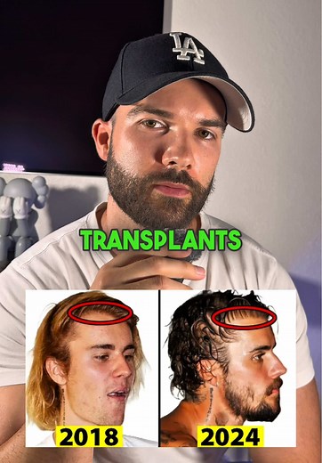 Celebrity Hair Transplant Results: Before and After