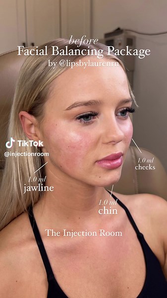 Facial balancing by @LipsbyLaurenRn 😍 #facialbalancing #filler #medspa #sanantoniomedspa #austinmedspa #medspalife