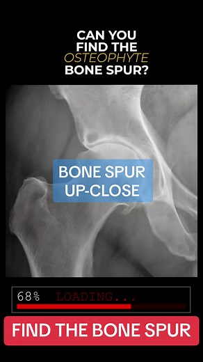 Bone spurs, or osteophytes, are smooth, bony growths, usually near joints. They develop over time in patients with arthritis or joint damage. The feet, hands, knees and spine often develop bone spurs. A healthy lifestyle can delay symptoms like pain, stiffness and limited motion #hiparthritis #handarthritis #osteoarthritisproblems #hipxray #bonespurs