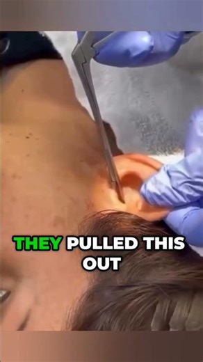 They Pulled THIS from Her Ear—Alive 🪳