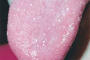 Small bumps on TONGUE could be new Covid symptom to look out for, docs warn