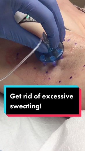 Get rid of wet armpits PERMANENTLY! #hyperhidrosis #miradry #armpit #sweating #doctor #miradry💧 #PepsiApplePieChallenge