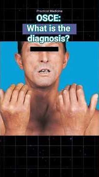 Skin thickening and tightening - What is the diagnosis? #osce #diagnosis #spotdiagnosis