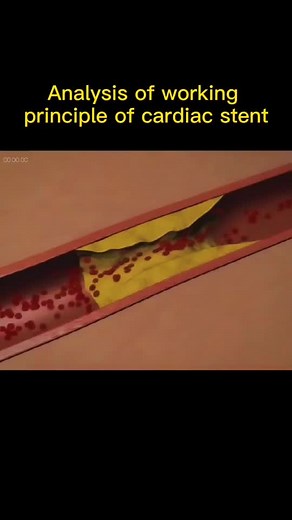 #cardiac #stent #working #principle #foryou #fypシ