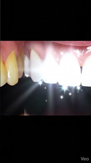 Complete Smile Makeover 😍 | Life-Changing Before & After