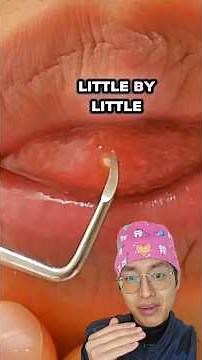 Transient Lingual Papillitis #TransientlingualPapillitis #liebump #pimple #health #tongue #shorts