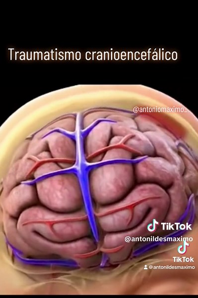 Traumatismo Cranioencefálico: Causas e Consequências