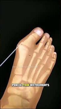 Minimally Invasive Hallux Valgus (Bunion) Surgery #halluxvalgus #bunionsurgery #bunioncorrection
