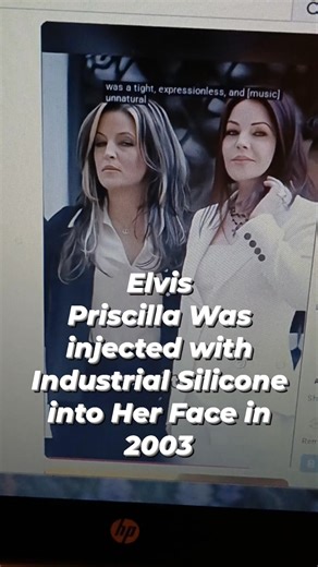 A fake doctor did the damage to her face. She tried desperately to correct the damage, but it just added stiffness to her face. | Birgit Martinez