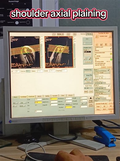 Understanding Shoulder Axial Plain Imaging Technique