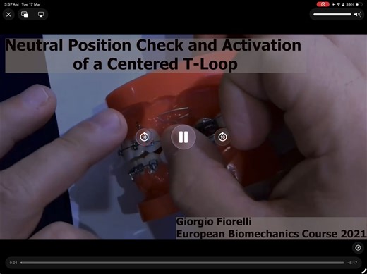 Typodont T-loop neutral position and activation