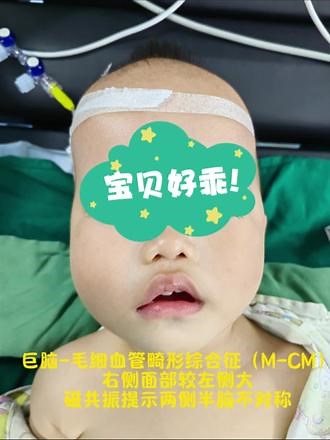 关注PROS综合征的孩子。 PIK3CA相关过度生长谱（PROS）是罕见脉管畸形综合征的总称，其特征是由PIK3CA基因体细胞突变引起的畸形和组织过度生长。包括K-T综合征，DCOM综合征，CLOVES综合征等等。临床表现多样，严重程度不一。本期介绍巨脑毛细血管畸形综合征。#福建省儿童医院白建喜 #罕见病 #PROS综合征 #综合征